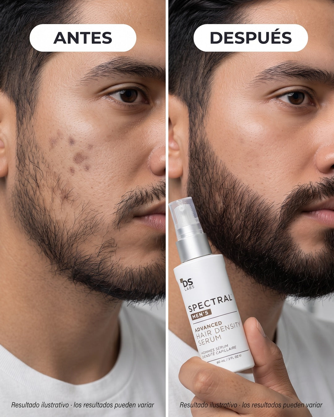 Antes y después · zona rala de la barba rellenada