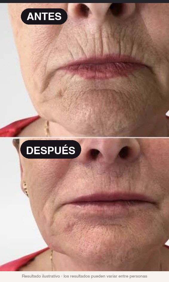 Antes y después · líneas del contorno de la boca
